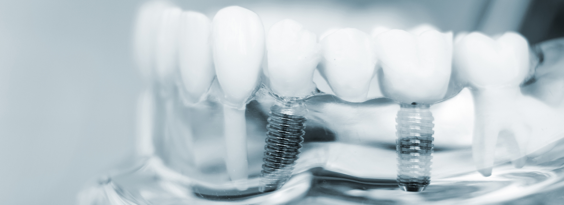 Claro Dental | Extractions, All-on-4 reg and Dental X-Rays